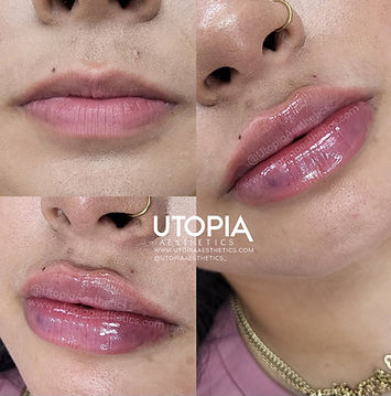 lip filler
