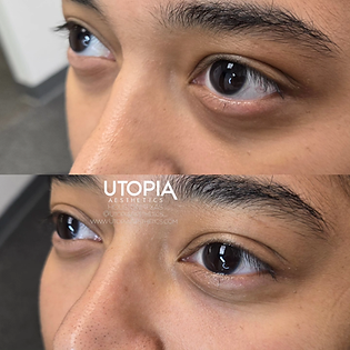 under eye filler