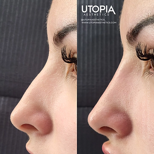 nose filler.jpg