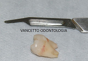 DENTE REMOVIDO.jpg