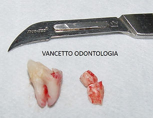 DENTE REMOVIDO 2.jpg