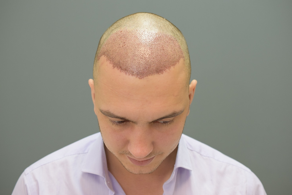 Hair Transplant in Dubai