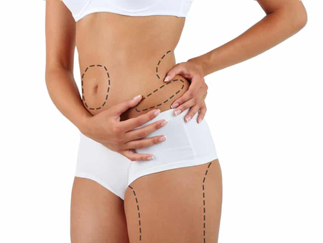Does Liposuction Work for Slimmer Thighs and Hips?