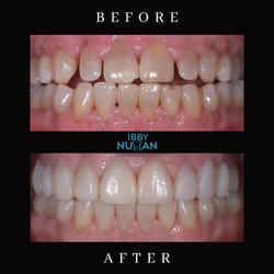 Smile Make Over
