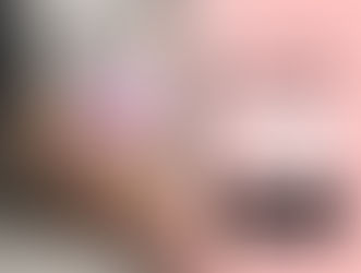 IPL PhotoFacial in Little Elm, TX: Results, Cost & Recovery