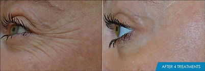 exilis_ultra_face_before_after_eyes.jpg