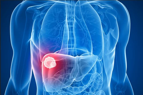 Step-by-step guide to getting an online second opinion for sarcoma from a U.S. hospital