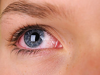 Dry Eyes