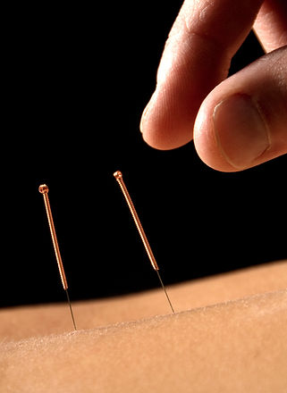 Acupuncture%20close%20up_edited.jpg