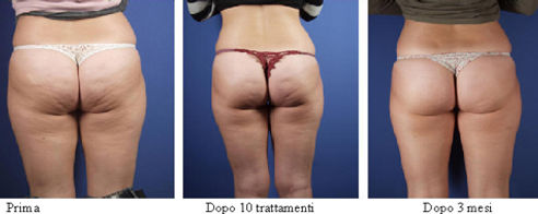 OSSIGENO TERAPIA CELLULITE A MILANO
