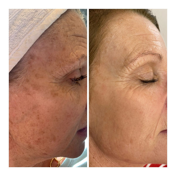 Illumi before and after.JPG