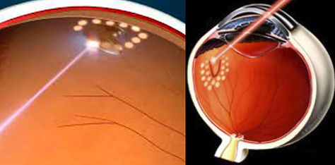 glaucoma-Clarity-oftalmologos-ojos-vision-glaucoma-retina-oftalmologia