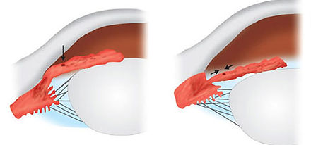 glaucoma-Clarity-oftalmologos-ojos-vision-glaucoma-retina-oftalmologia