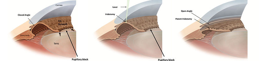 LASER-PERIPHERAL-IRIDOTOMY-glaucoma-Clarity-oftalmologos-ojos-vision-glaucoma-retina-oftalmologia