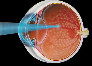 glaucoma-Clarity-oftalmologos-ojos-vision-glaucoma-retina-oftalmologia