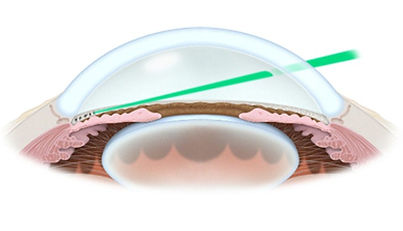 SLT-glaucoma-Clarity-oftalmologos-ojos-vision-glaucoma-retina-oftalmologia