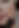 Dermal Filler injections using highest quality fillers