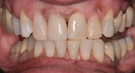 Blanchiment avant_après.jpg