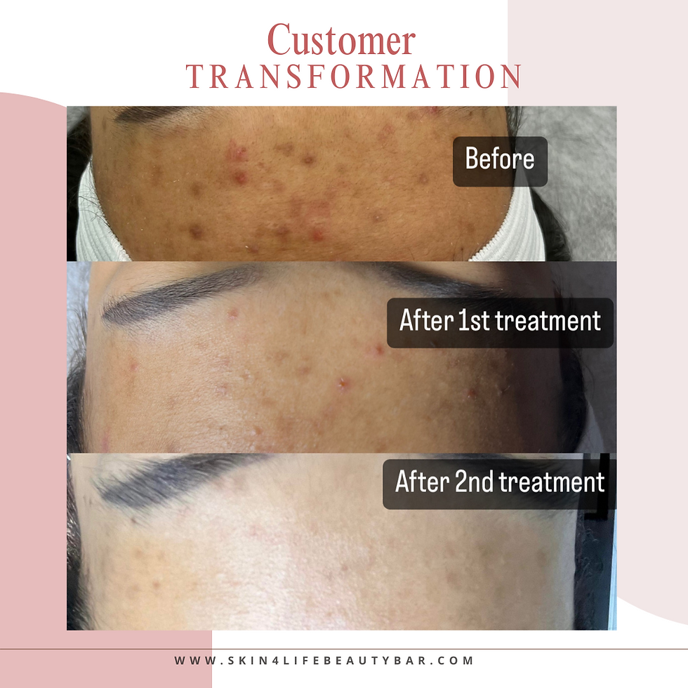 Before and After Microneedling