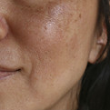 melasma.jpeg