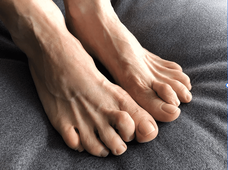 Hammer Toes