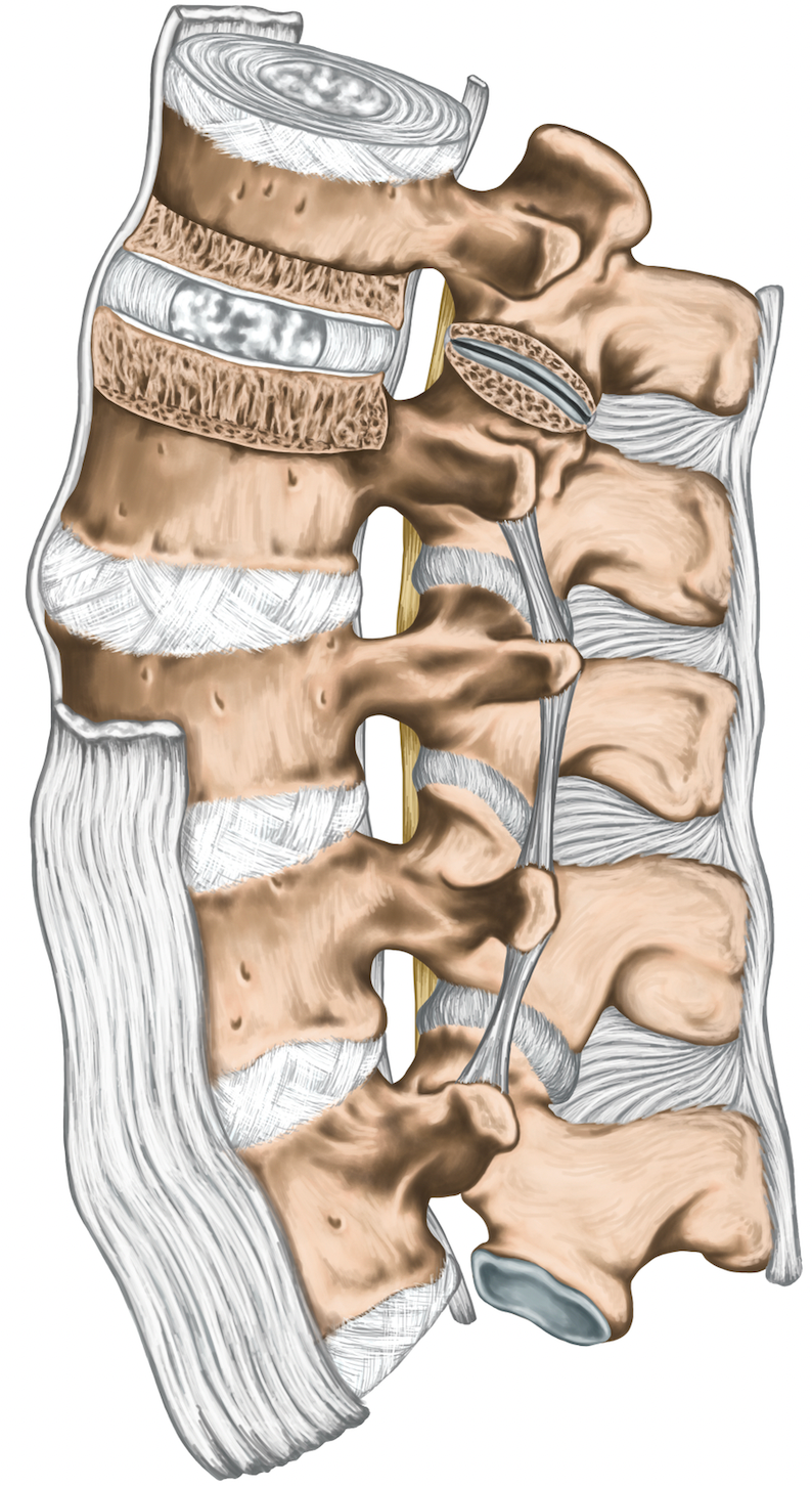 Ligament Thickening Image