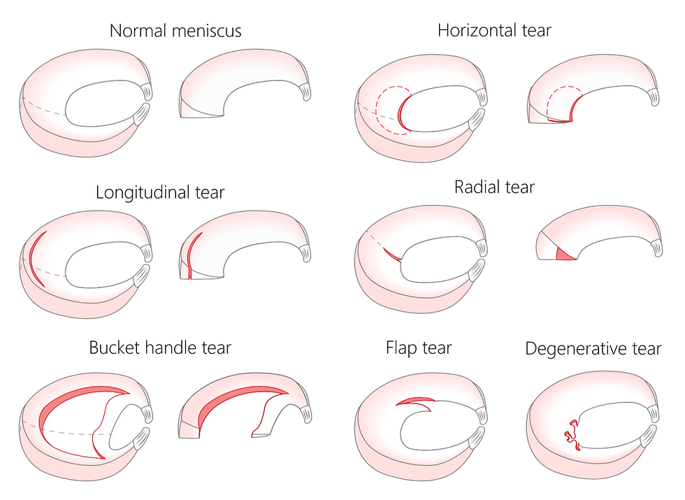 Types of Meniscus Tears
