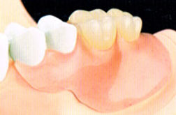 denture02.jpg