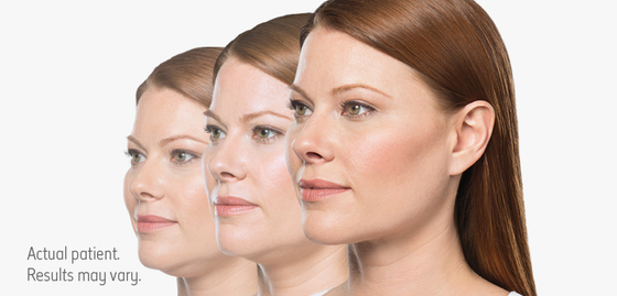 It’s time to update your OTHER profile with Kybella!