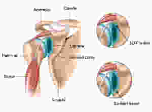 Diagram explaining Bankart and Slap labrum tear