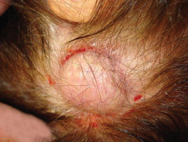 Pilar cyst
