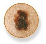 MELANOMA SKIN CANCER.jpg