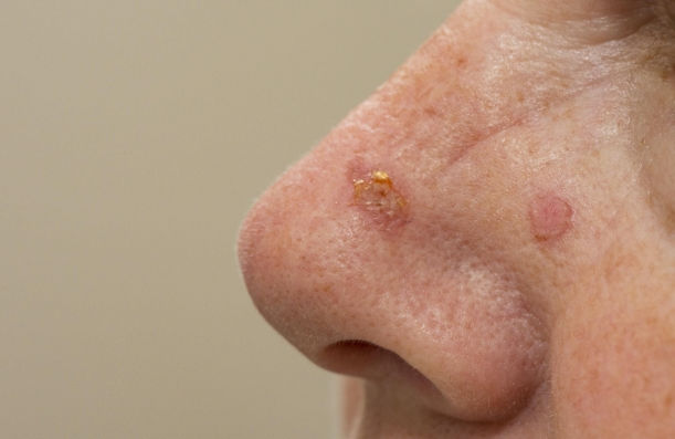 Actinic Keratosis
