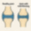 Mild Degenerative Arthrosis: Meaning, Symptoms, and Care