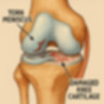A close-up illustration of a torn meniscus and damaged knee cartilage