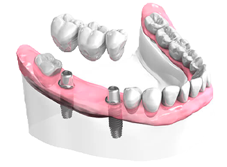 bridge sur implant