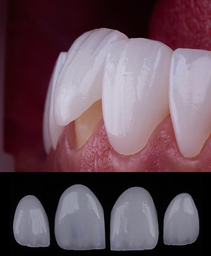 FACETTE VENNERS
