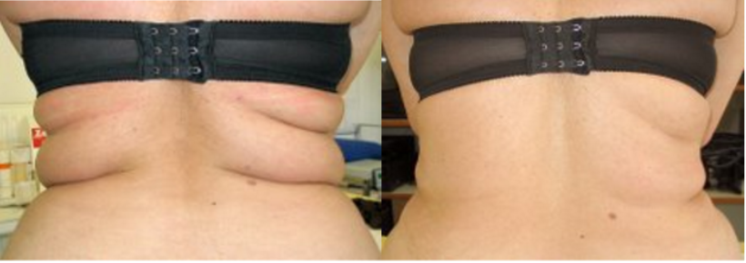 Body Contouring