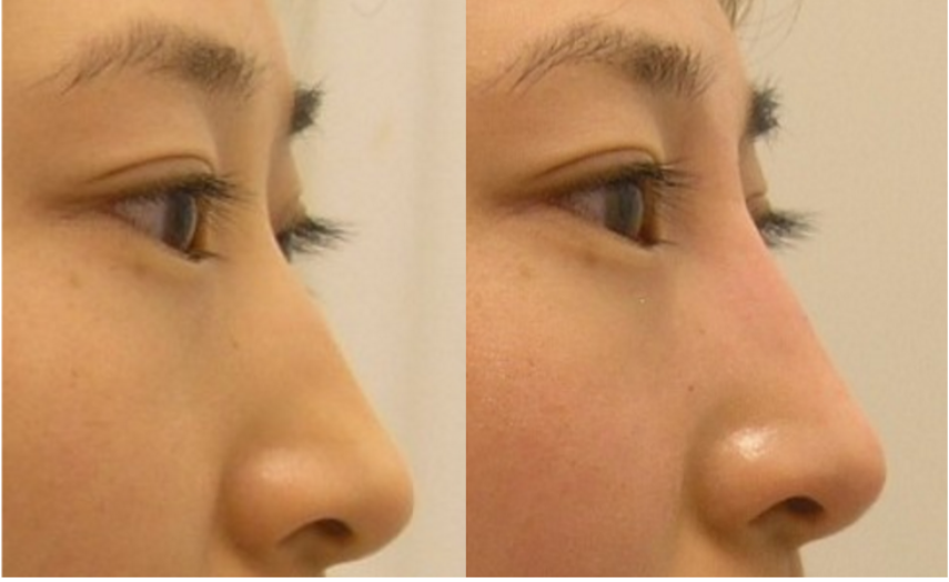 Non surgical nose enhancement or nos