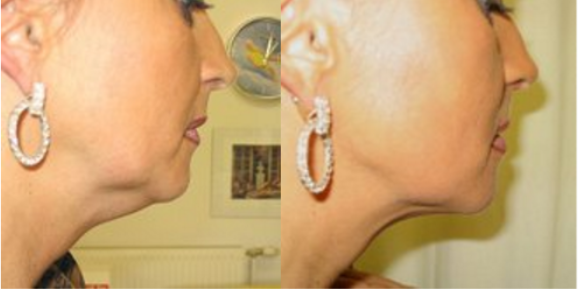 Body Contouring