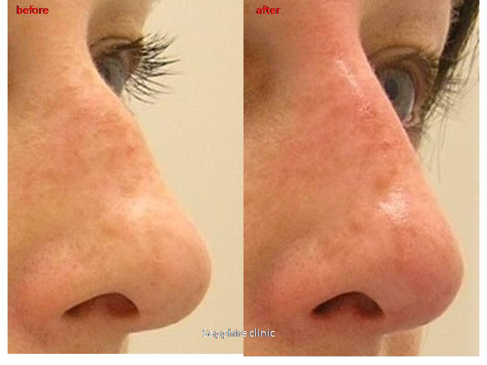 Nose/Chin Shaping