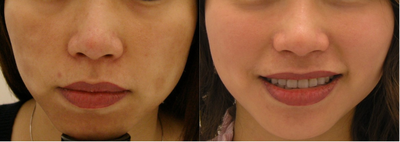Melasma