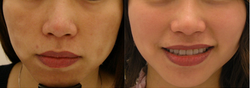 Melasma
