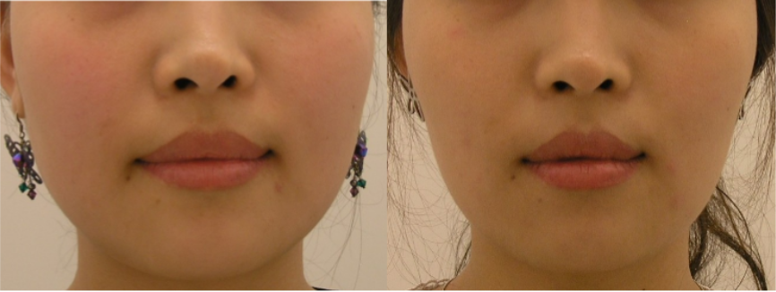 Facial Shaping