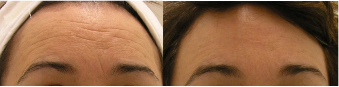 Forehead horizontal line and fine li