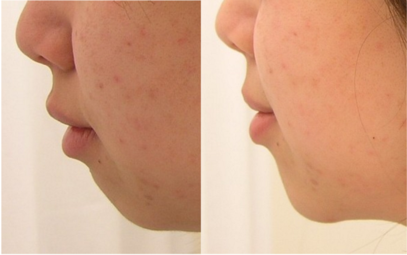Non surgical Chin enhancement by usi