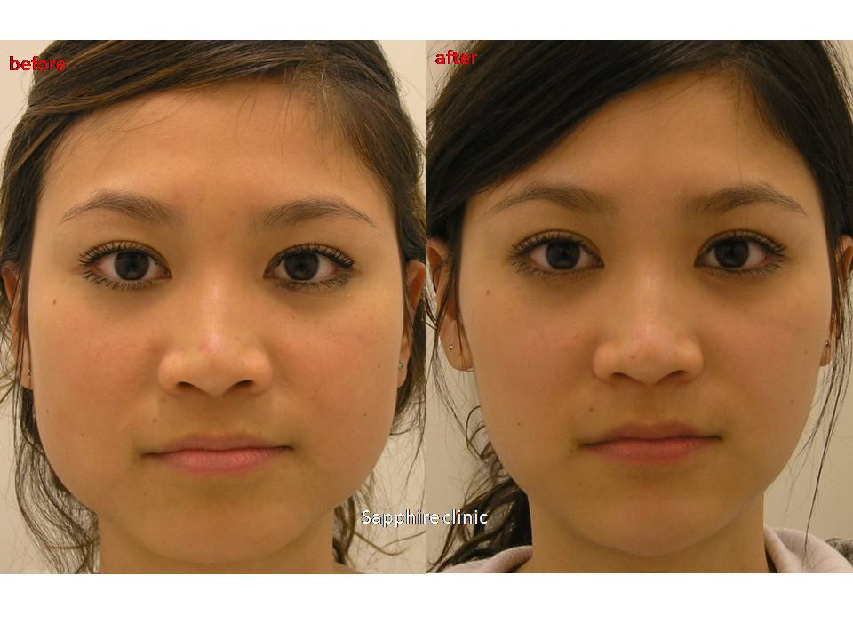 Facial Shaping