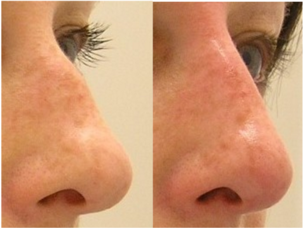 Non surgical nose enhancement