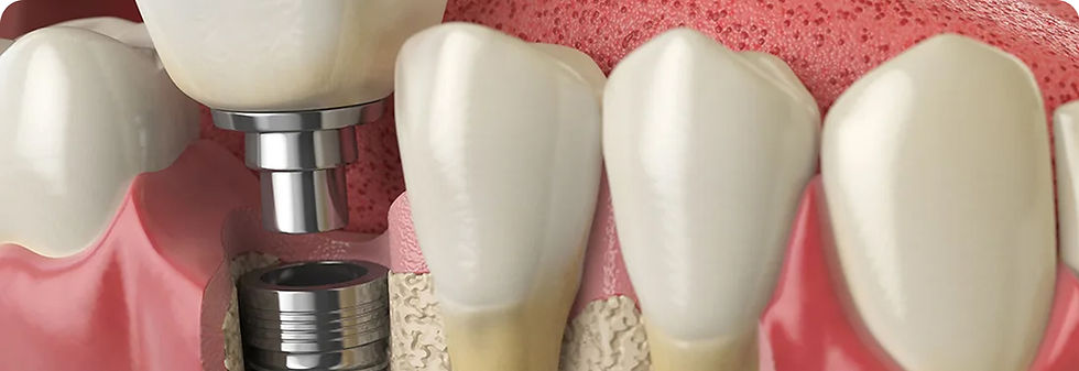 Dental Implants.jpg