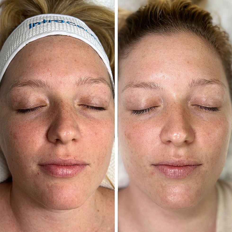 Two close-up images show a woman's face before and after an Intraceuticals Oxygen facial treatment. Left: freckled skin. Right: smoother complexion. Eyes closed.